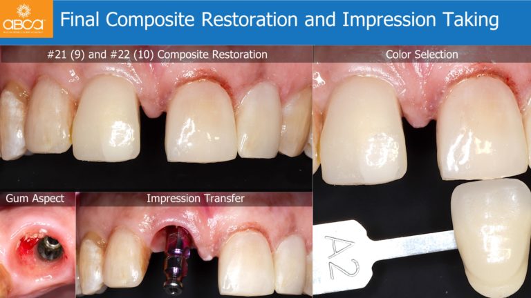 Immediate Loading in the Aesthetic Zone of Tooth 